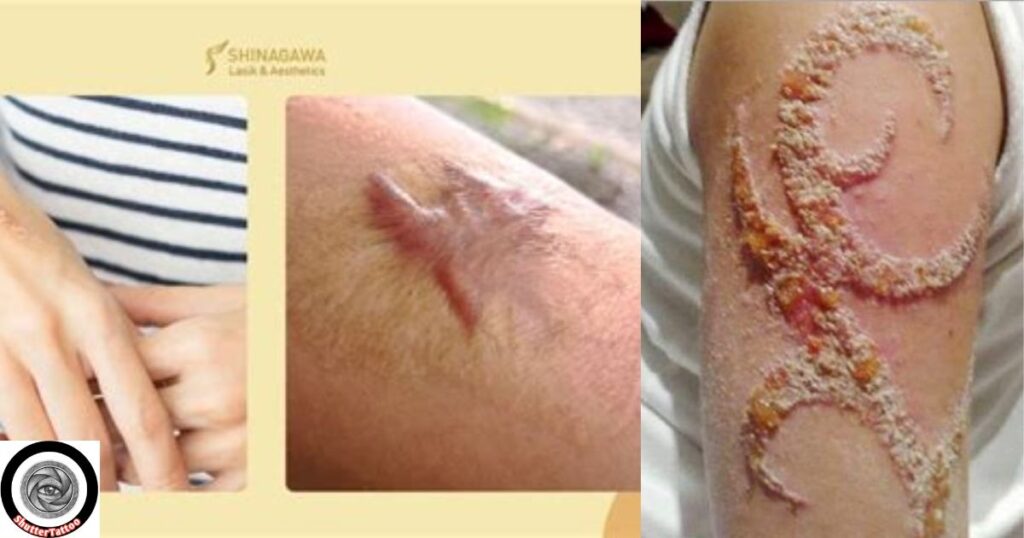 Types of Scars Suitable for Skin Tone Tattoo