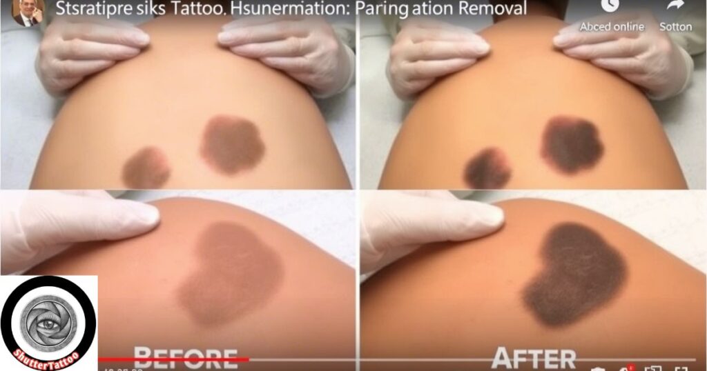 Risks to Avoid: Hyperpigmentation, Hypopigmentation, and Scarring